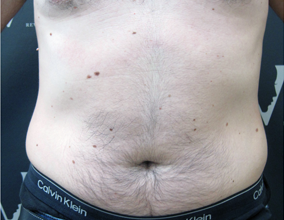 Fat reduction for male love-handles before 3265126