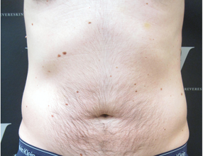 Fat reduction for male love-handles after 3265126