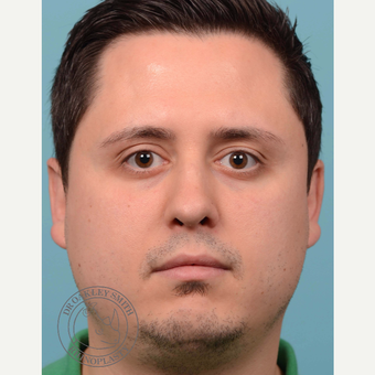 35-44 year old man treated with Revision septoplasty/rhinoplasty with rib graft before 3092774