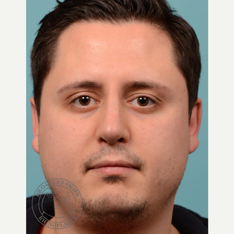 35-44 year old man treated with Revision septoplasty/rhinoplasty with rib graft after 3092774