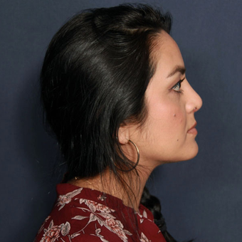 25-34 year old woman treated with Rhinoplasty (view 2 of 2) after 3617509
