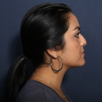 25-34 year old woman treated with Rhinoplasty (view 2 of 2) before 3617509