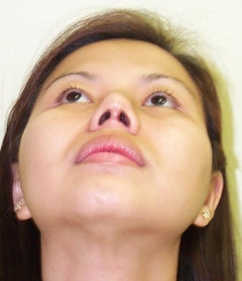Asian Rhinoplasty after 684233