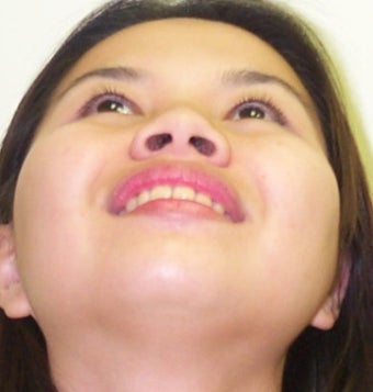 Asian Rhinoplasty before 684233