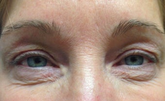 45-54 year old woman treated with Eyelid Surgery before 3367443