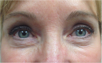45-54 year old woman treated with Eyelid Surgery after 3367443