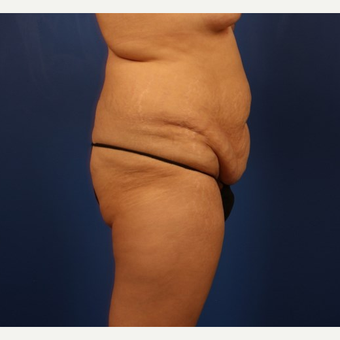Fat Transfer before 3743798