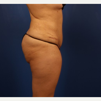 Fat Transfer after 3743798