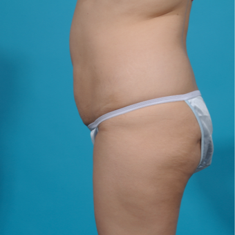 25-34 year old man treated with Brazilian Butt Lift before 3282725