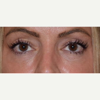 45-54 year old woman treated with CO2 Laser after 3642985