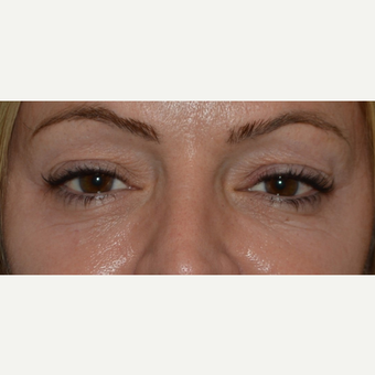 45-54 year old woman treated with CO2 Laser before 3642985