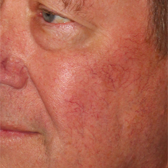 64 year old man treated with Pulsed Dye Laser and Cool Touch Varia after 3414079