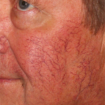 64 year old man treated with Pulsed Dye Laser and Cool Touch Varia before 3414079