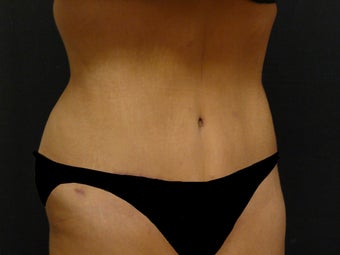 Abdominoplasty (Tummy Tuck) 975818