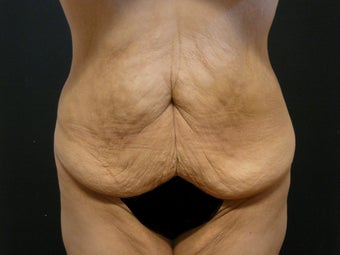 Abdominoplasty (Tummy Tuck) before 975818
