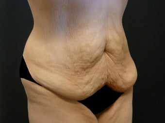 Abdominoplasty (Tummy Tuck) 975818