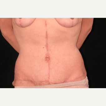 35 year old woman treated with Tummy Tuck after 3052699