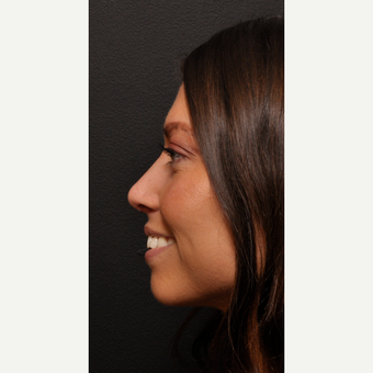 Rhinoplasty after 3523808
