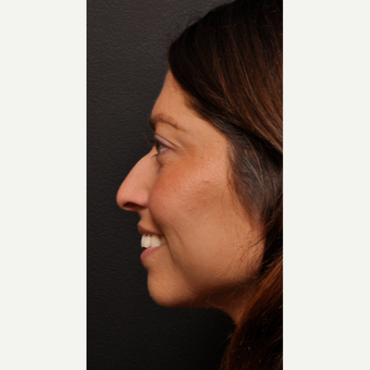 Rhinoplasty before 3523808