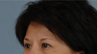 45-54 year old woman treated with Asian Eyelid Surgery before 3615811