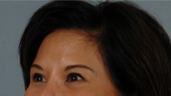 45-54 year old woman treated with Asian Eyelid Surgery after 3615811