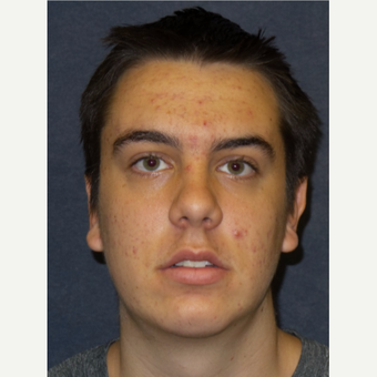 18-24 year old man treated with Chin Implant after 3467255