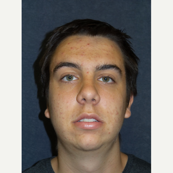 18-24 year old man treated with Chin Implant before 3467255