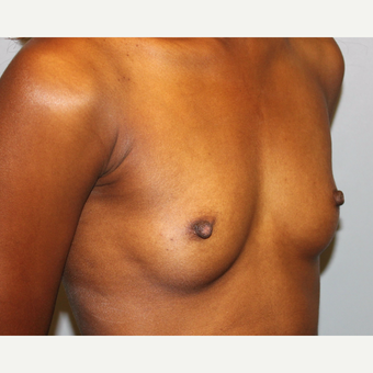 25-34 year old woman treated with Breast Augmentation before 3815629