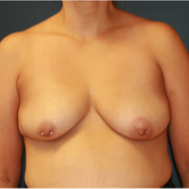 35-44 year old woman treated with Breast Lift with Implants before 3554345