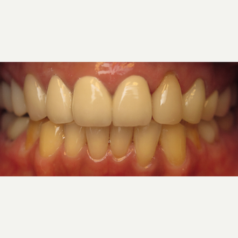 45-54 year old woman treated with Dental Crown after 3260818