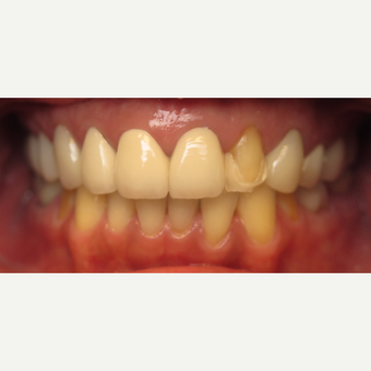 45-54 year old woman treated with Dental Crown before 3260818