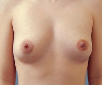 Natural Breast Enhancement, Two Cup Sizes Larger after 1474860