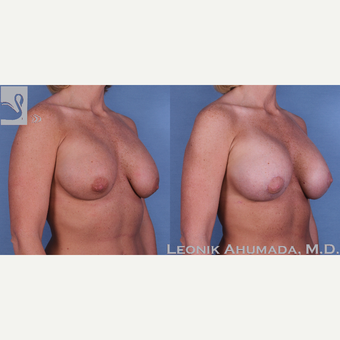 25-34 year old woman treated with Saline implant removal and Silicone implant replacement with lift after 3093392