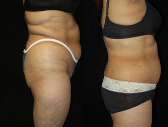 66 Year-Old Woman Treated for Bulky Fat of Bra Rolls, Flanks, and Waist 837441