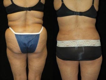 66 Year-Old Woman Treated for Bulky Fat of Bra Rolls, Flanks, and Waist before 837441