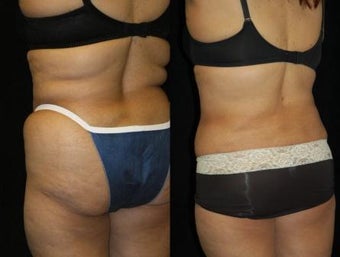 66 Year-Old Woman Treated for Bulky Fat of Bra Rolls, Flanks, and Waist after 837441
