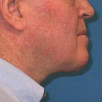 45-54 year old man treated with Neck Lift after 3497173