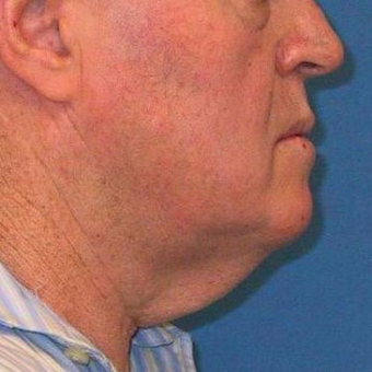 45-54 year old man treated with Neck Lift before 3497173