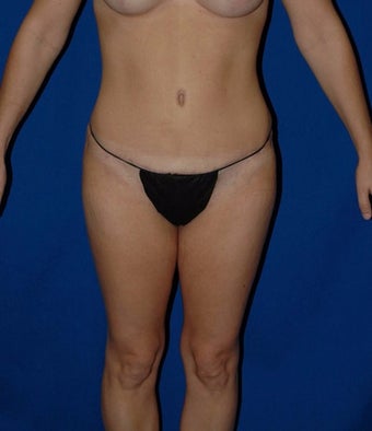 35-44 year old woman treated with SAFELipo after 3126133