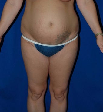 35-44 year old woman treated with SAFELipo before 3126133
