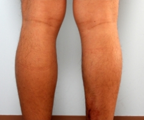 Calf Implants before 934895