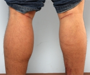 Calf Implants after 934895