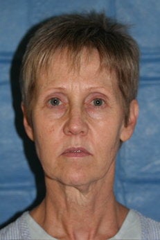 Endoscopic Brow lift, Facelift, Lower Blepharoplasty - Frontal view before 53215