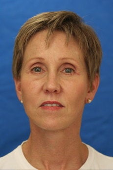 Endoscopic Brow lift, Facelift, Lower Blepharoplasty - Frontal view after 53215
