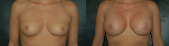 32 Year Old Female Treated for Breast Augmentation before 1075163