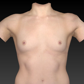 18-24 year old woman treated with Breast Augmentation before 3771100