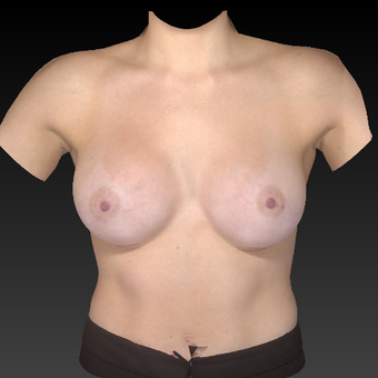 18-24 year old woman treated with Breast Augmentation after 3771100