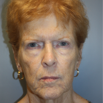 65-74 year old woman treated with Facelift before 3808357
