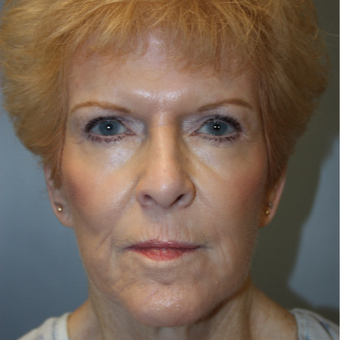 65-74 year old woman treated with Facelift after 3808357