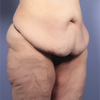 45-54 year old woman treated with Body Lift before 3666050